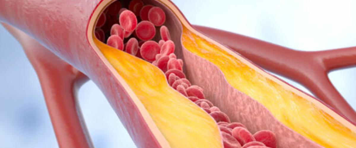 stockatherosclerosis.jpg