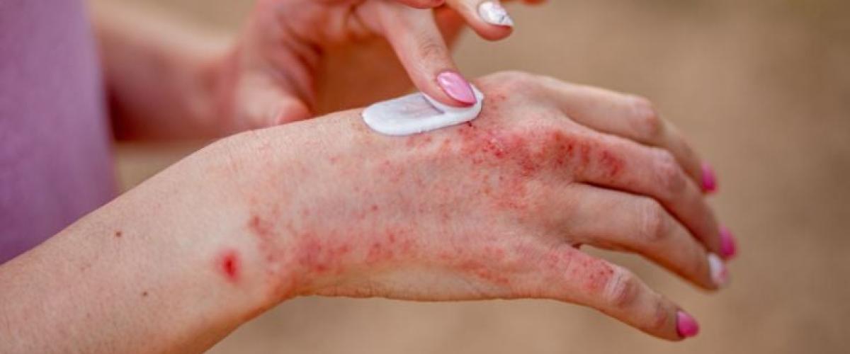 eczema