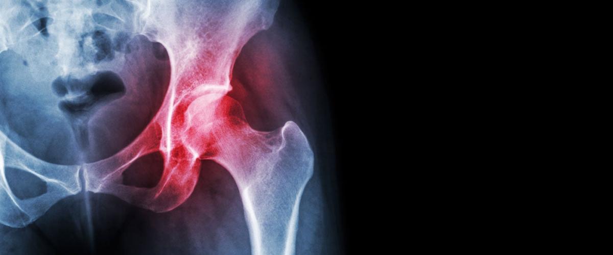 osteoarthritis-feat