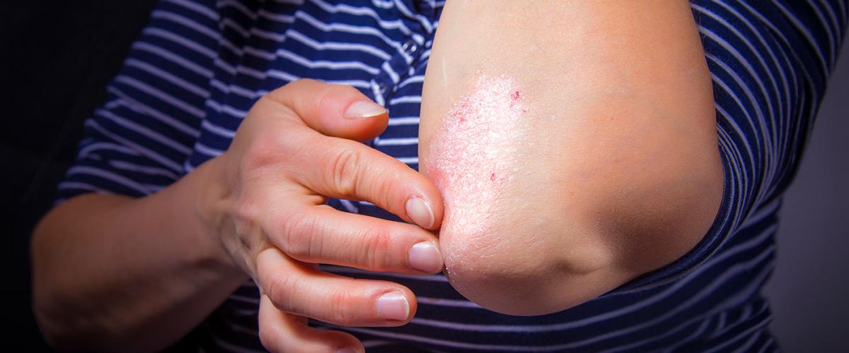 psoriasis-elbow-feat
