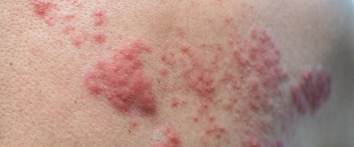 shingles-rash