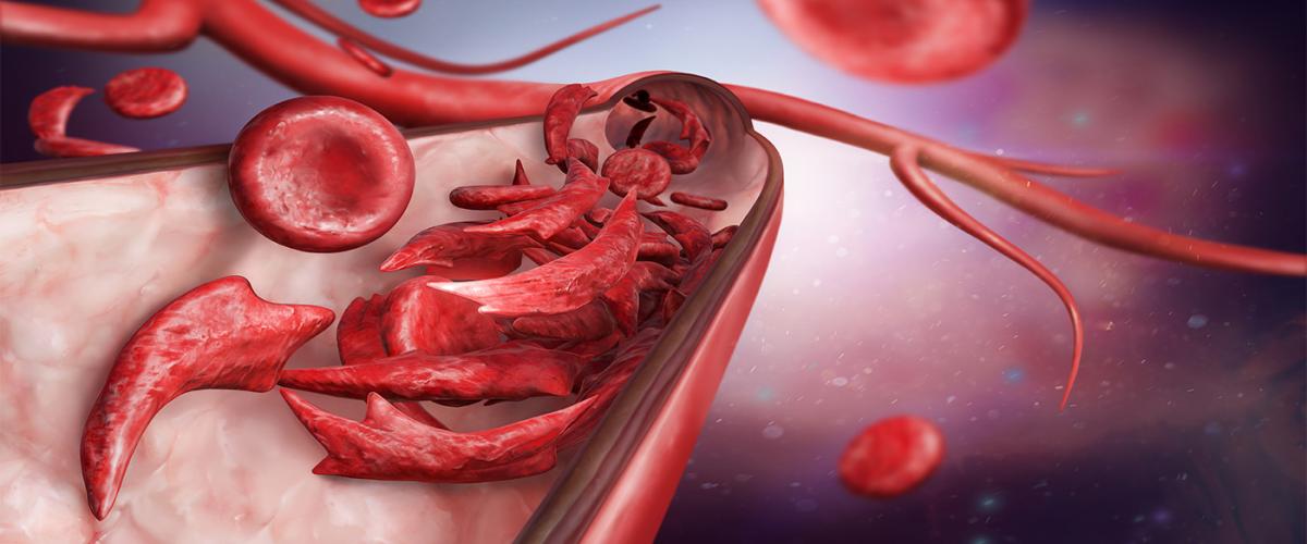 sickle-cells