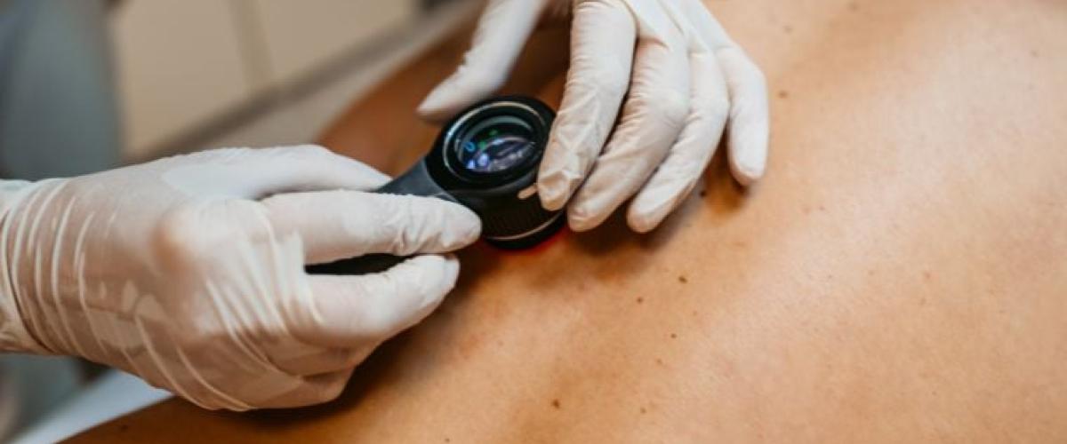 skin-cancer-examination