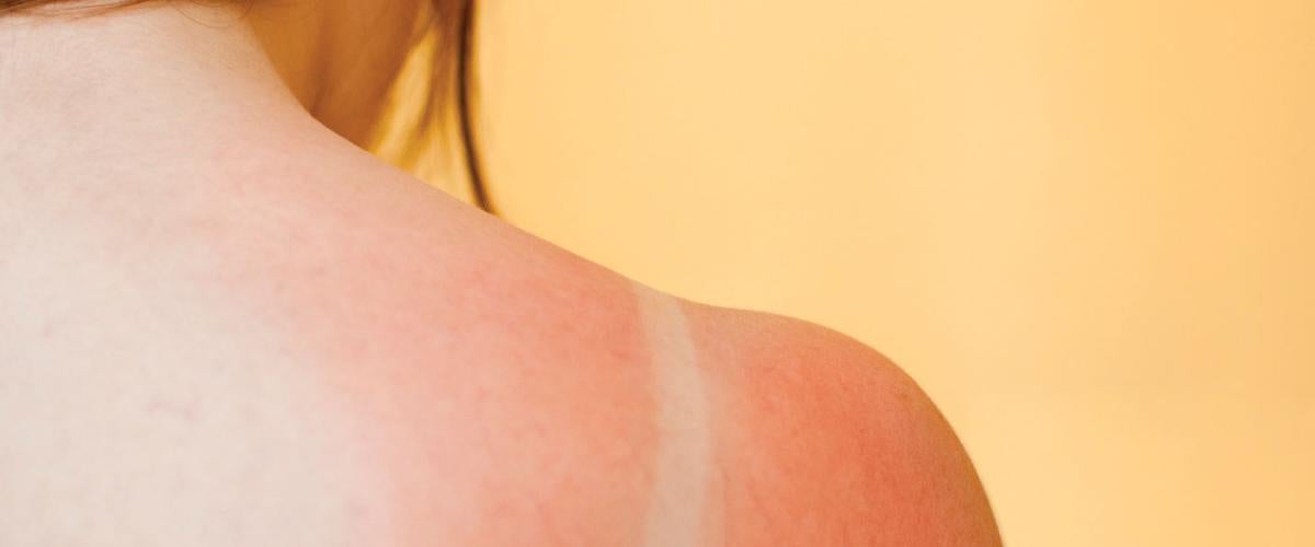 sunburn