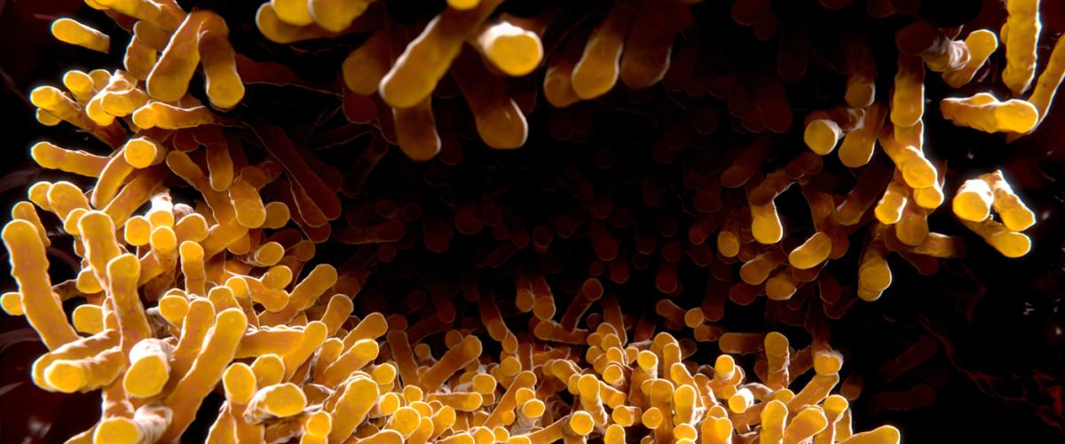 tuberculosis
