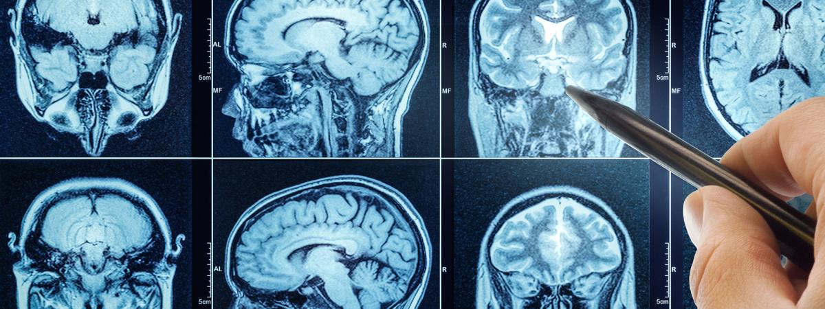 Photo of a doctor's hand pointing to a spot on MRI scans of the brain