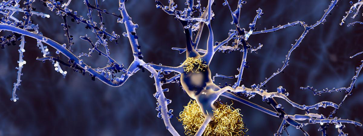 Amyloid-Placque