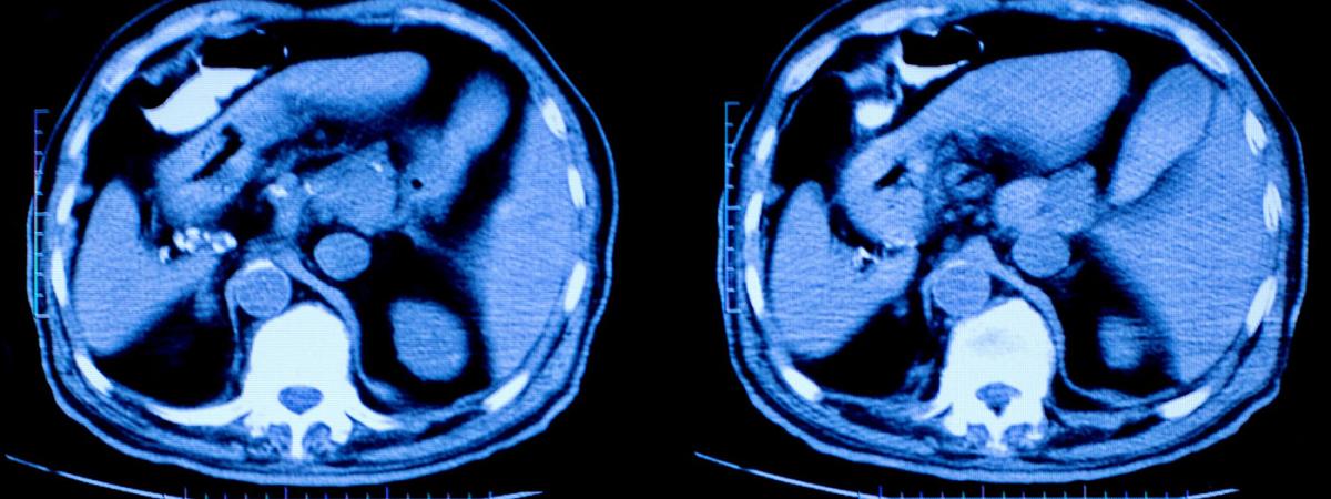 MRI