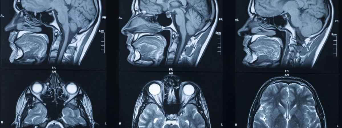brain-scan-feat