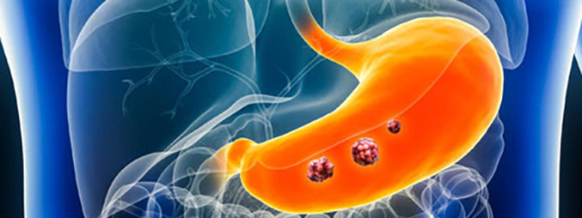 169gastriccancer.jpg