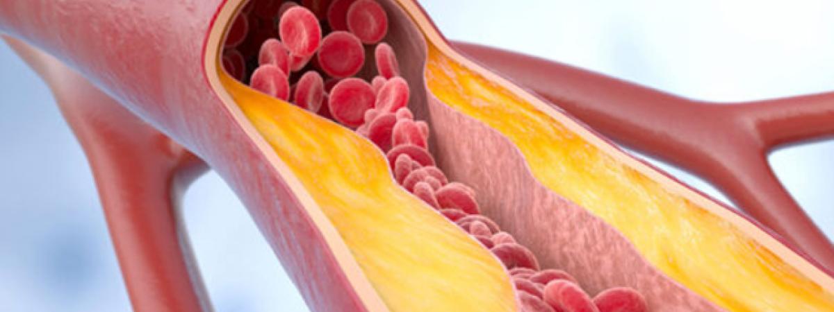 stockatherosclerosis.jpg