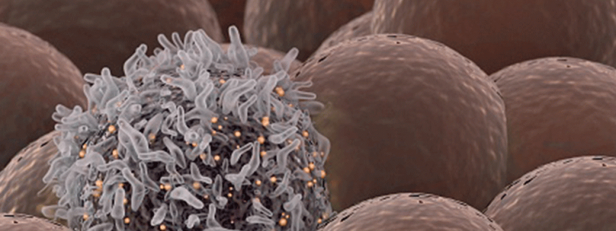 lung_cancer