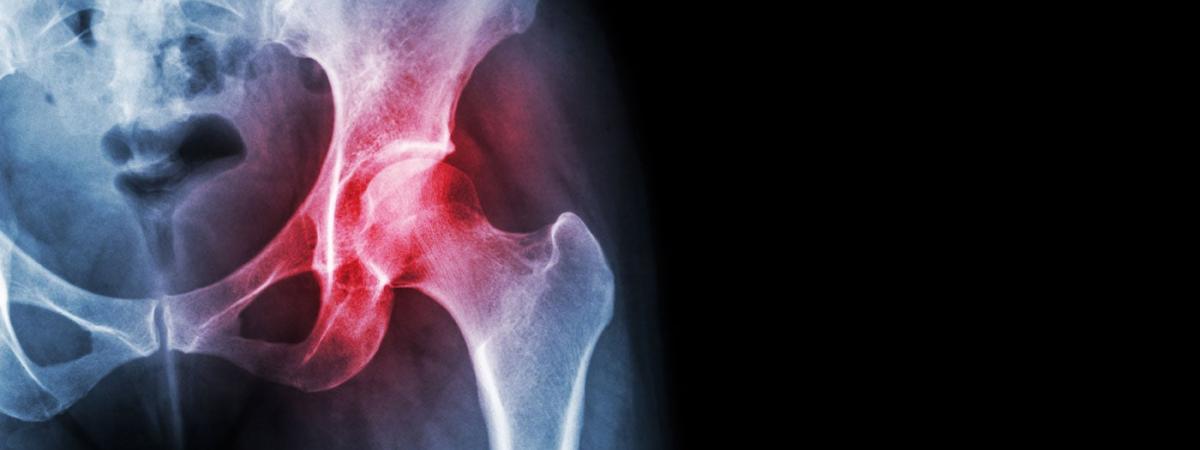 osteoarthritis-feat