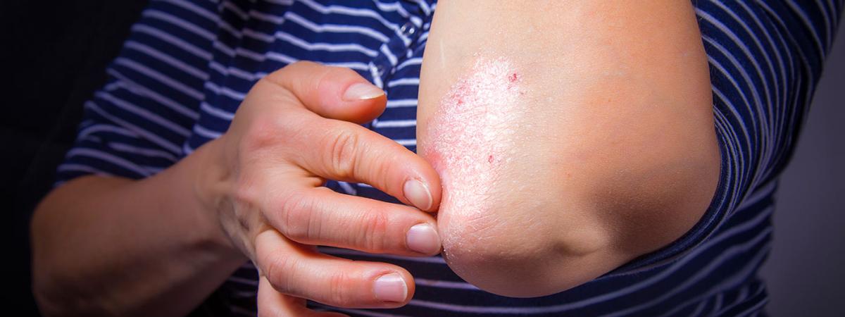 psoriasis-elbow-feat