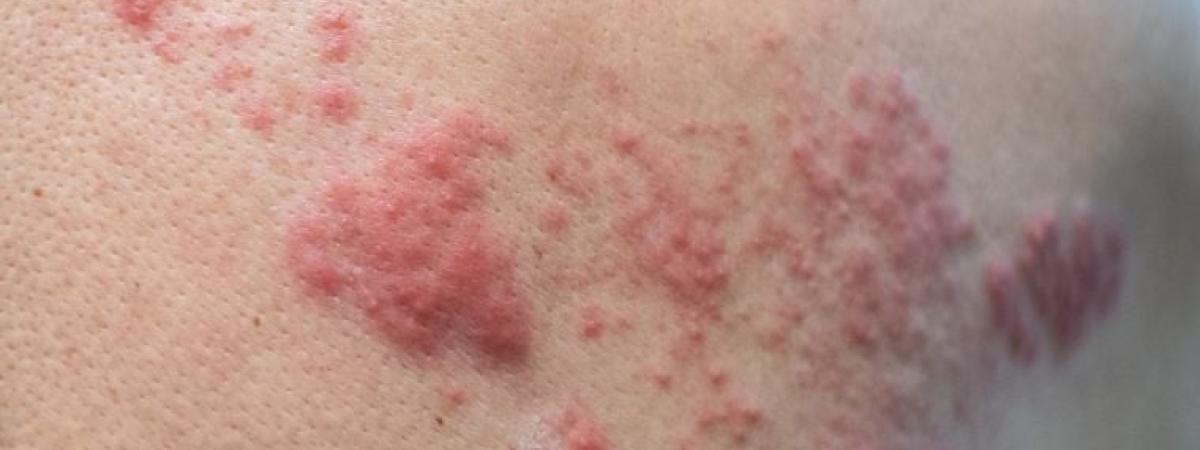 shingles-rash