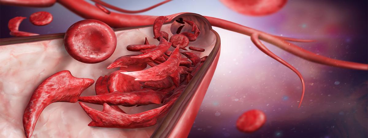 sickle-cells