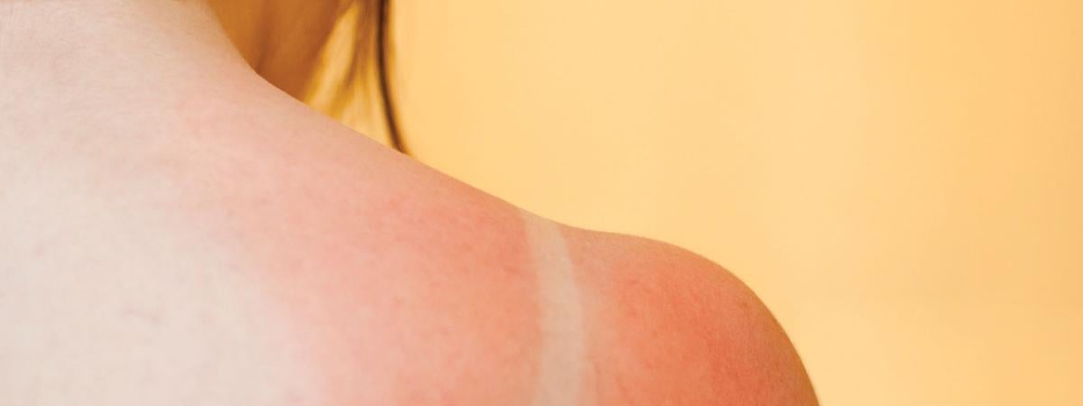 sunburn