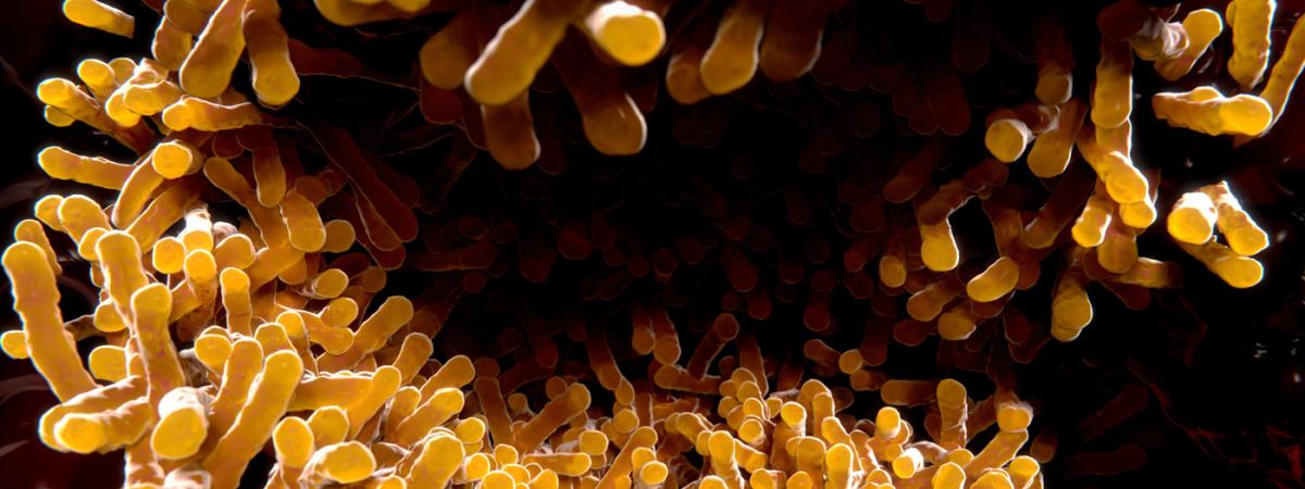 tuberculosis