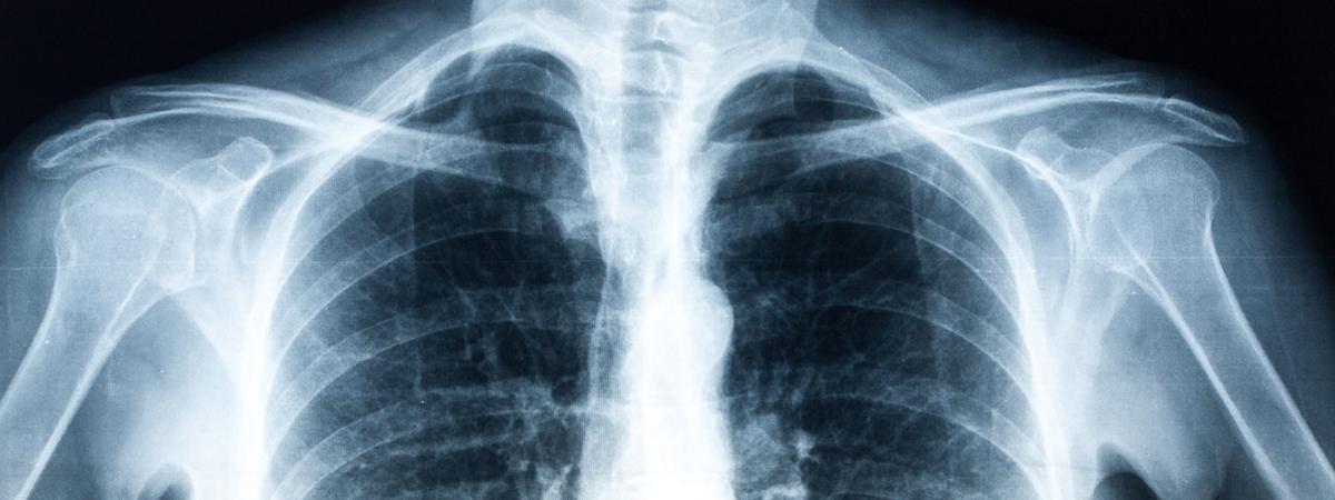 x-ray
