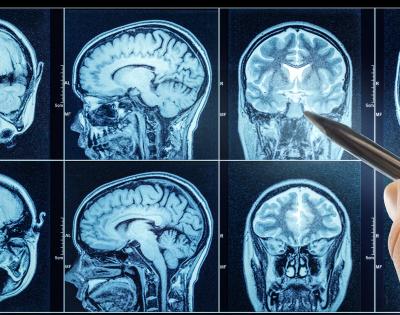Photo of a doctor's hand pointing to a spot on MRI scans of the brain