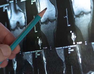 Close up photo of a doctor pointing to a spot on an x-ray of bones