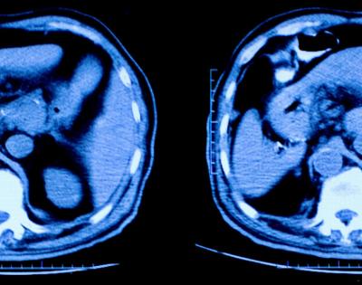 MRI