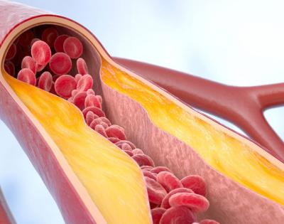atherosclerosis-feat