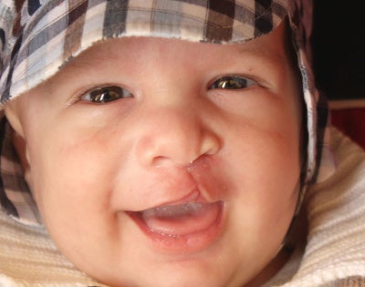 cleft-palate