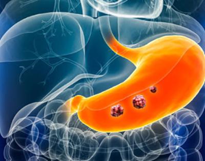 169gastriccancer.jpg