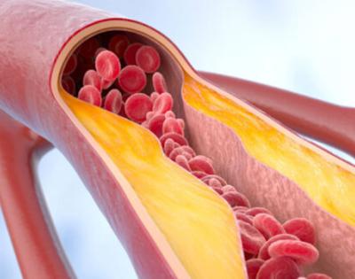 stockatherosclerosis.jpg