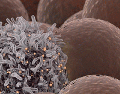 lung_cancer