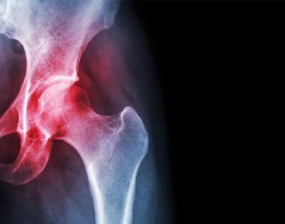 osteoarthritis-feat