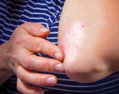 psoriasis-elbow-feat
