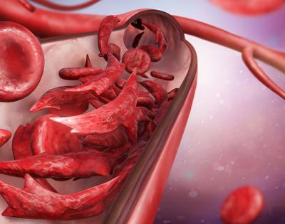 sickle-cell-feat