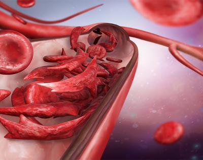 sickle-cells