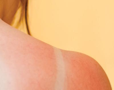 sunburn