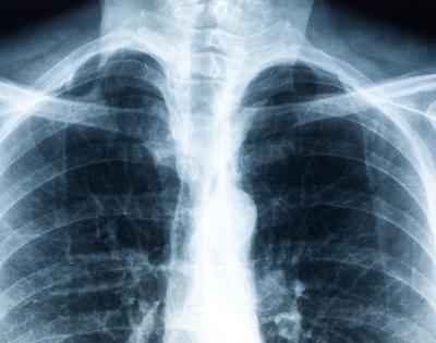 x-ray