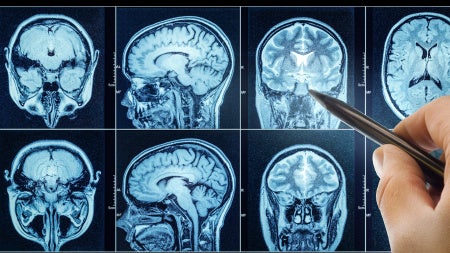 Photo of a doctor's hand pointing to a spot on MRI scans of the brain