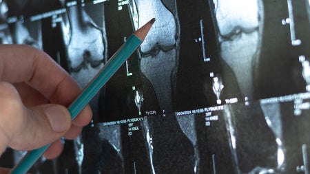 Close up photo of a doctor pointing to a spot on an x-ray of bones