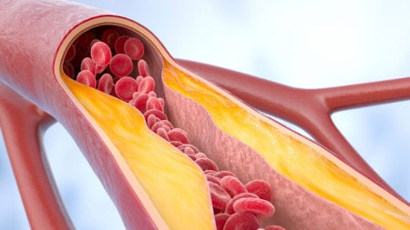 atherosclerosis-feat