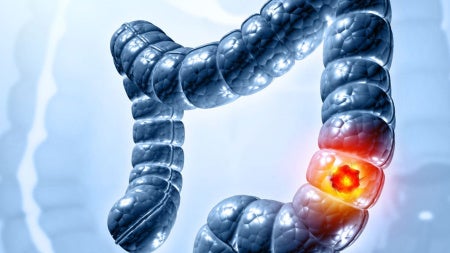 colorectal-cancer-feat