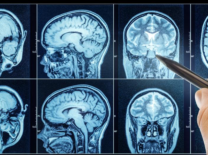 Photo of a doctor's hand pointing to a spot on MRI scans of the brain
