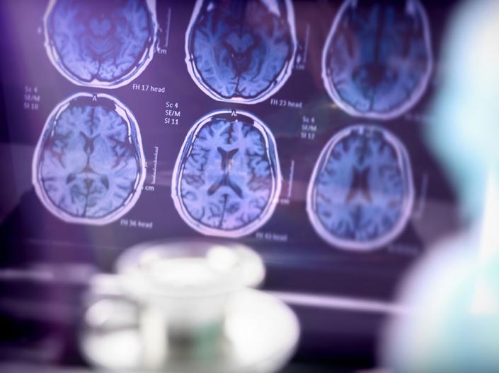X-ray image of a brain scan