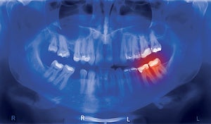 An x-ray of a person's teeth