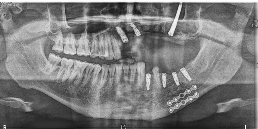 An x-ray showing a set of teeth after reconstructive surgery