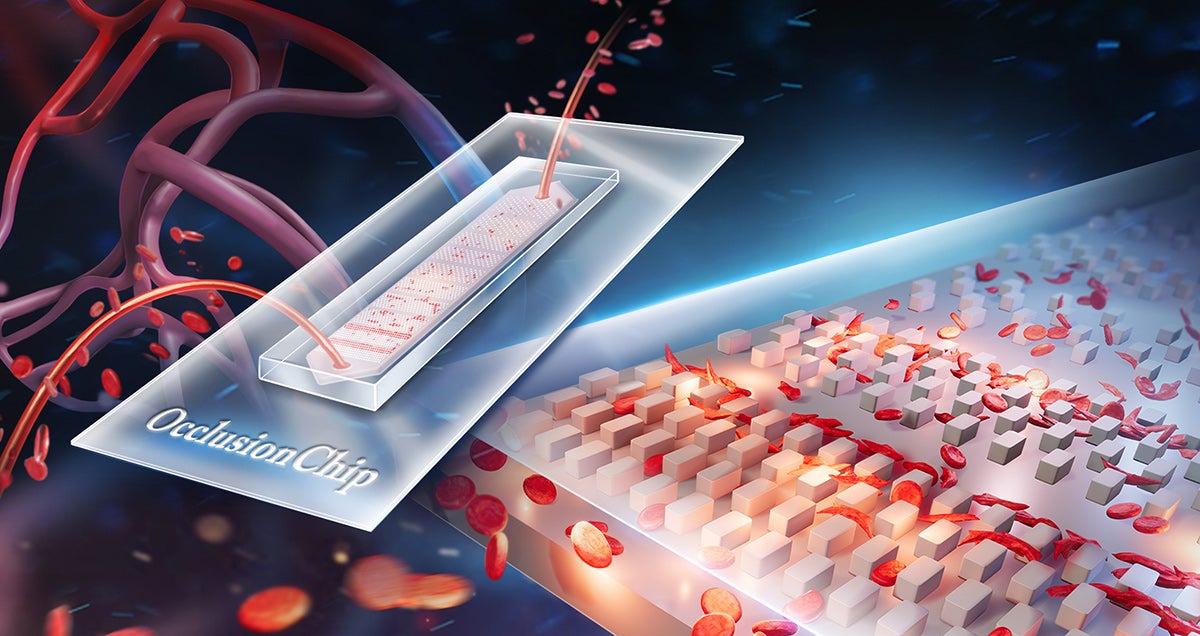 Illustration of test that measures deformities in red blood cells