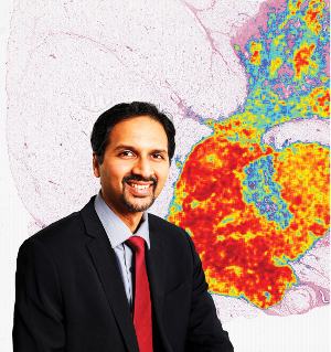 Anant Madabhushi has uncovered clues in images of cancerous cells that could improve disease diagnosis and prognosis, and lead to better treatment recommendations. Now he aims to take his innovation global. The breast-cancer image behind him is the result of a machine-learning algorithm developed by his group to identify invasive breast cancer on tissue scans.